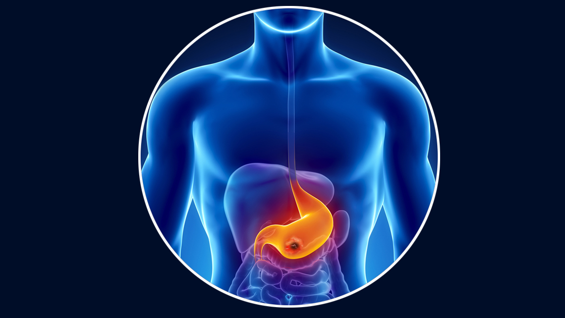 Consultation médecin Juan AMARIS spécialiste gastro-enterologie à paris. Ulcère gastrique et ulcère duodénal. Le traitement de l’ulcère.